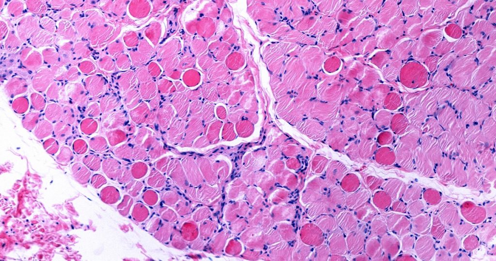 Necrotic Muscle Fiber Duchenne Distrophy